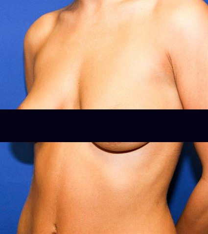 Is an Internal Bra Lift a Safe Breast Lift Procedure? - Dr. Zoran Potparic