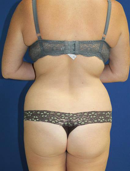 Your Checklist for a Perfect Tummy Tuck - Plastic Surgery Specialists of  South Florida